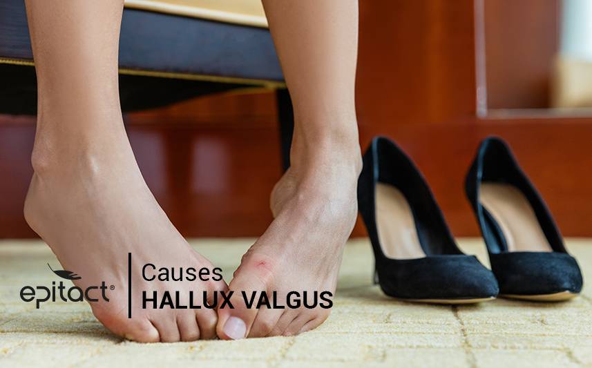 Quelles sont les causes de l’hallux valgus ?