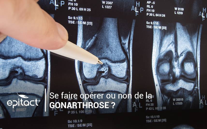 Se faire opérer ou non de la gonarthrose