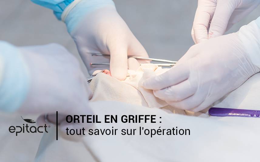 Tout savoir sur l’opération de l’orteil en griffe