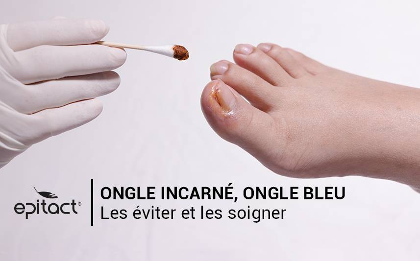 Soigner un ongle incarné et un ongle bleu