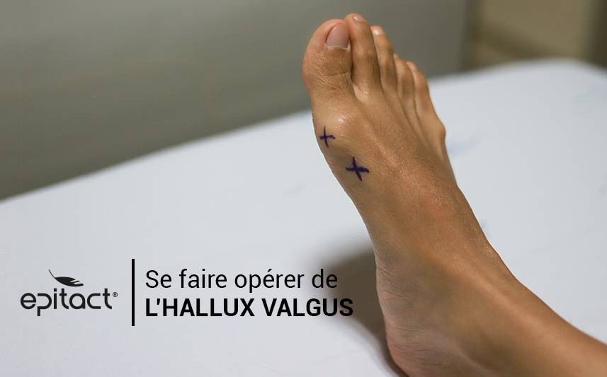 Se faire opérer ou non d’un hallux valgus