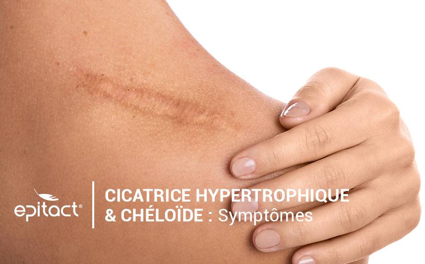 Cicatrice chéloïde & cicatrice hypertrophique : symptômes