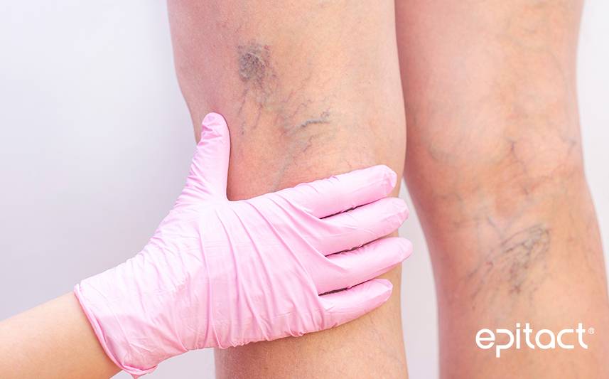 Varices : définition, causes, symptômes