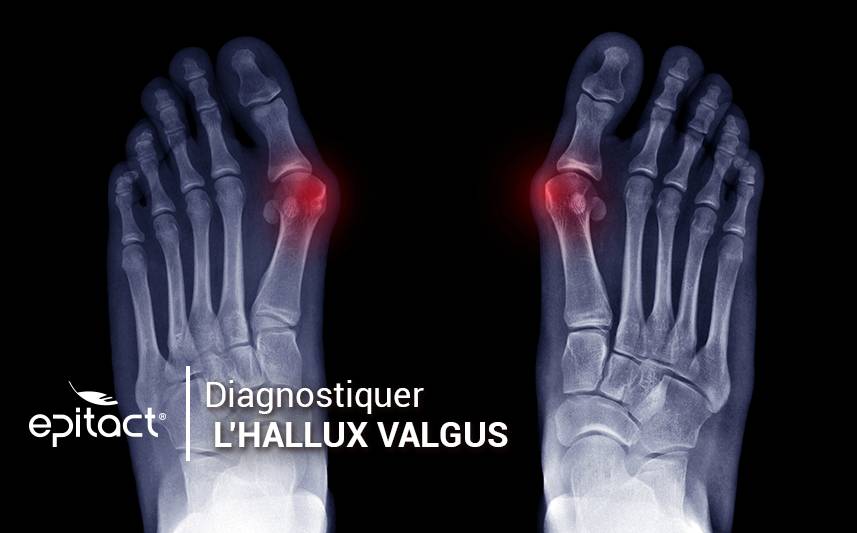 Comment diagnostiquer un hallux valgus ou « oignon »