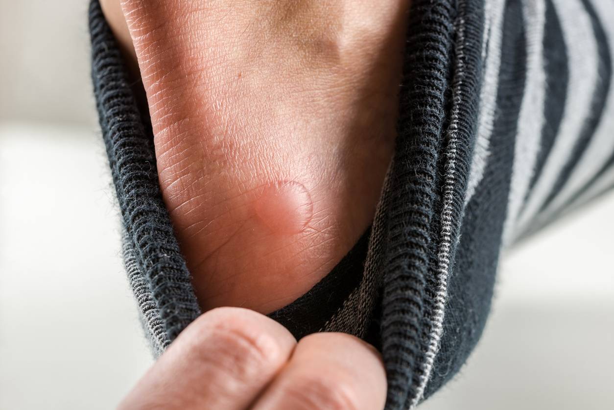 Tout savoir sur l'ampoule au pied