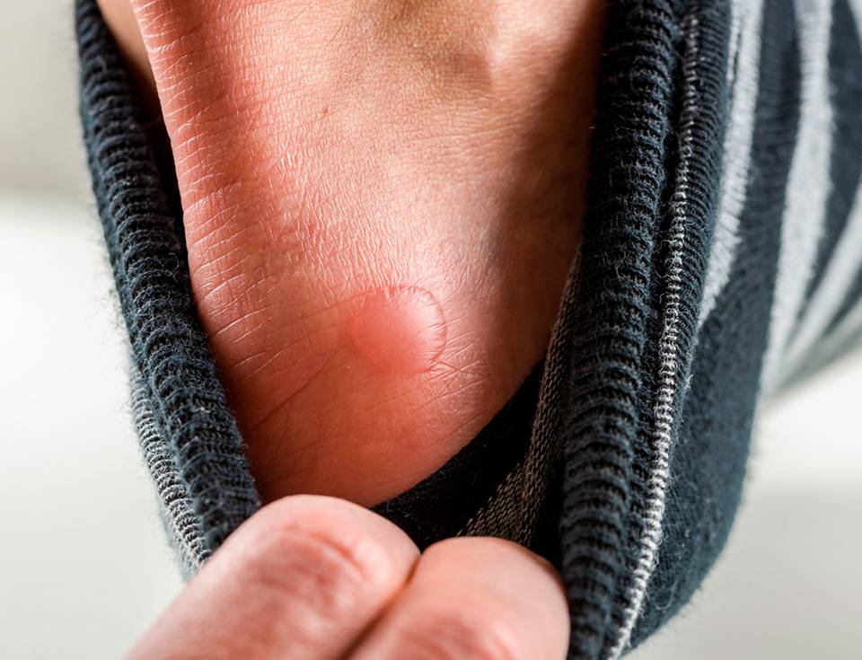 Tout savoir sur l'ampoule au pied