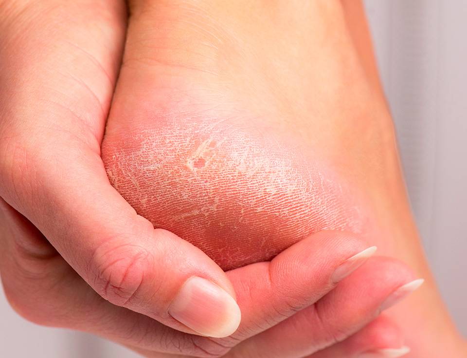 Exfoliation des pieds