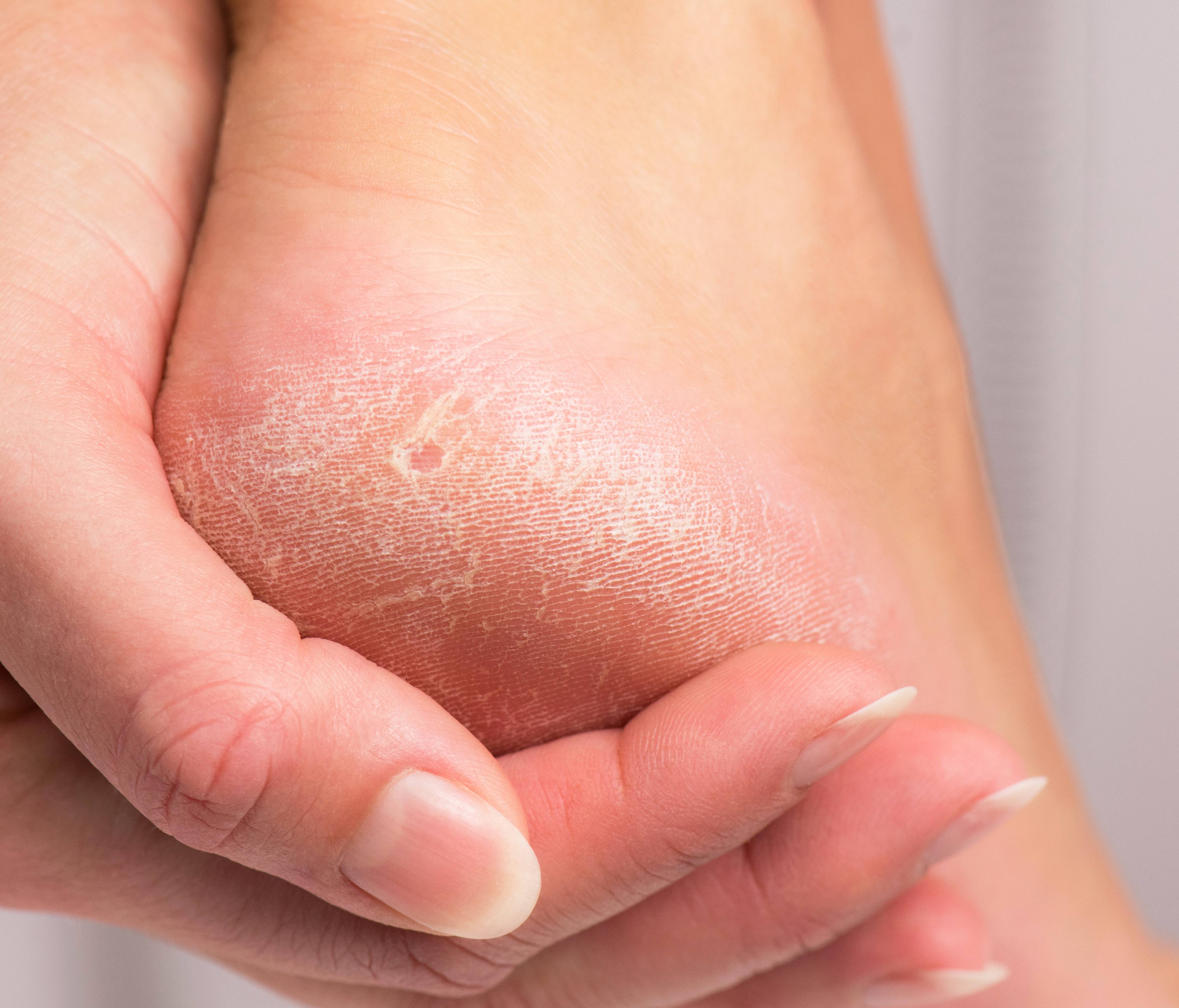 Exfoliation des pieds